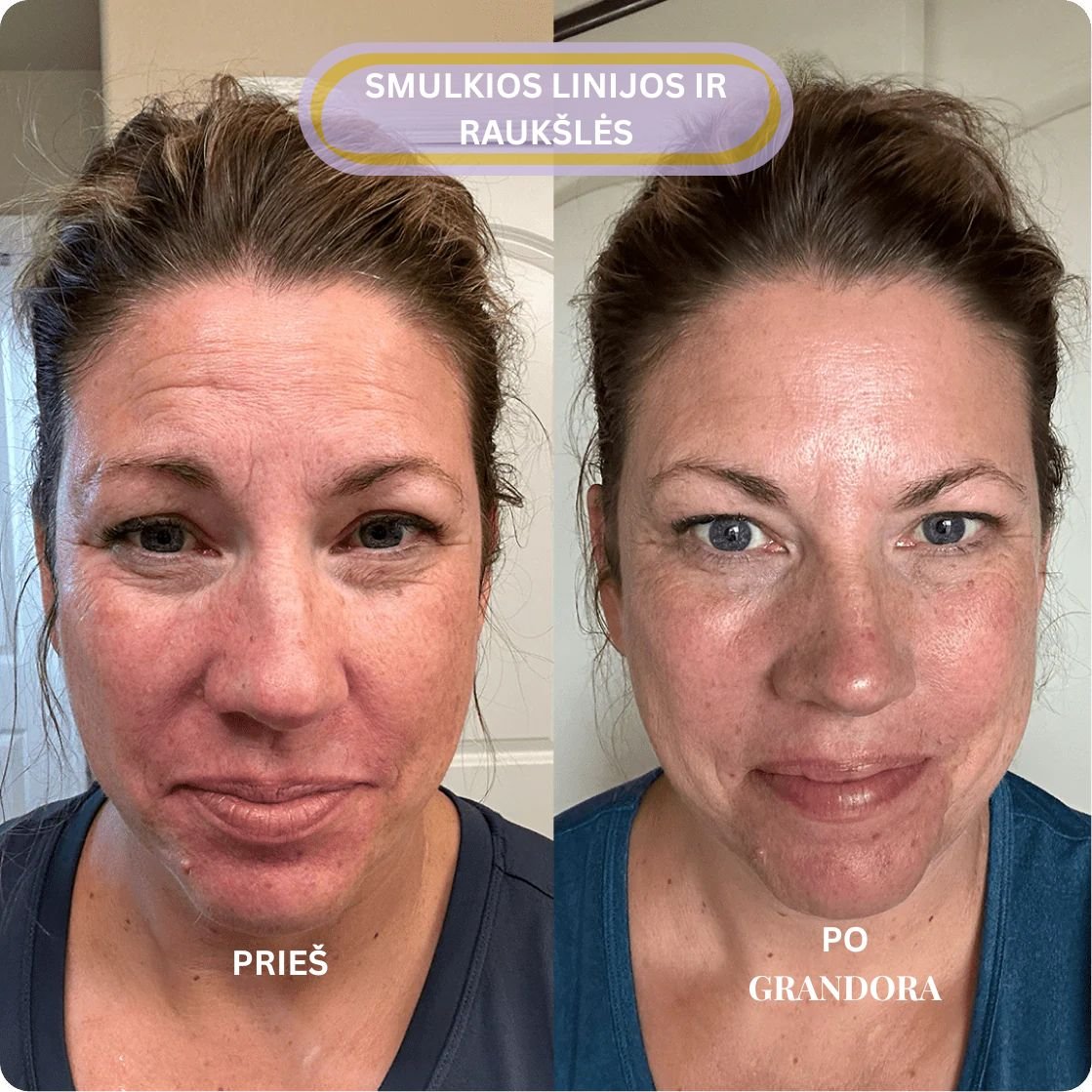 Smulkios linijos ir raukšlės