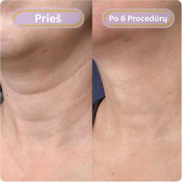 Prieš ir po – raukšlėtas / suglebęs kaklas