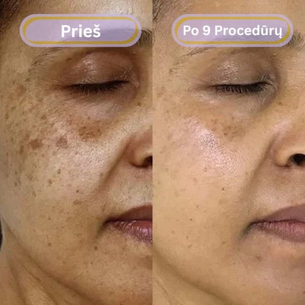 Prieš ir po – pigmentinės ir amžiaus dėmės
