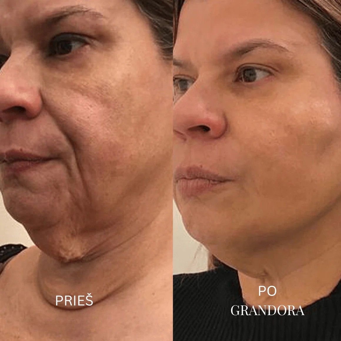 Prieš ir Po – Grandora rezultatai